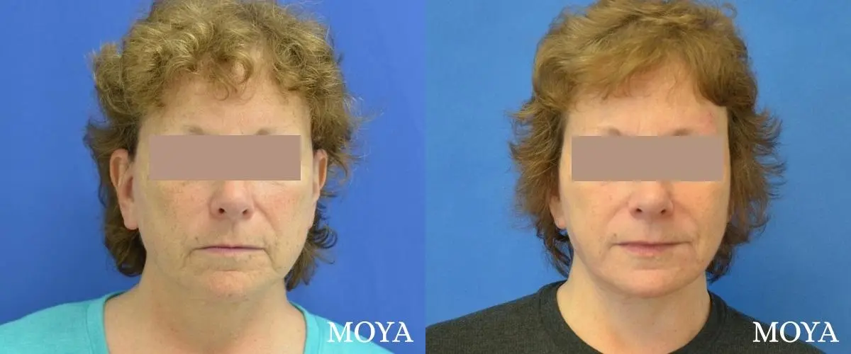 Neck Lift: Patient 6 - Before and After  