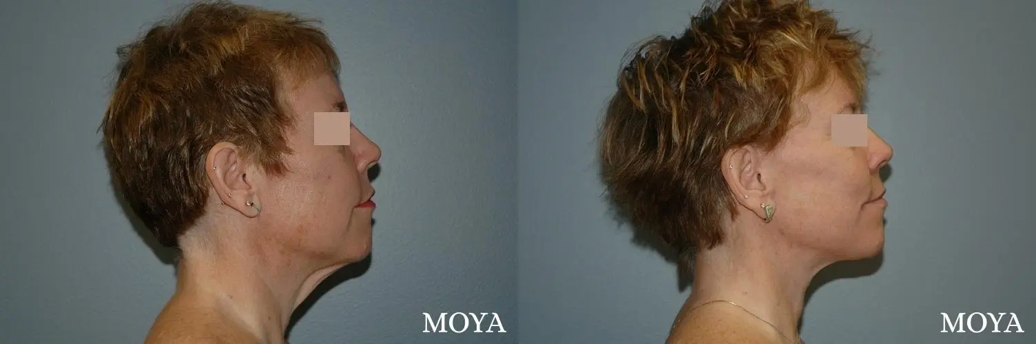 Neck Lift: Patient 2 - Before and After 2