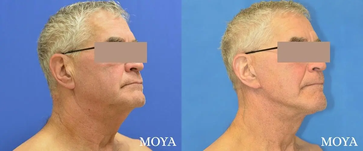Neck Lift: Patient 4 - Before and After 2