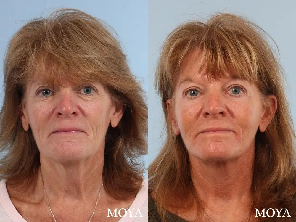 Neck Lift: Patient 3 - Before and After 1