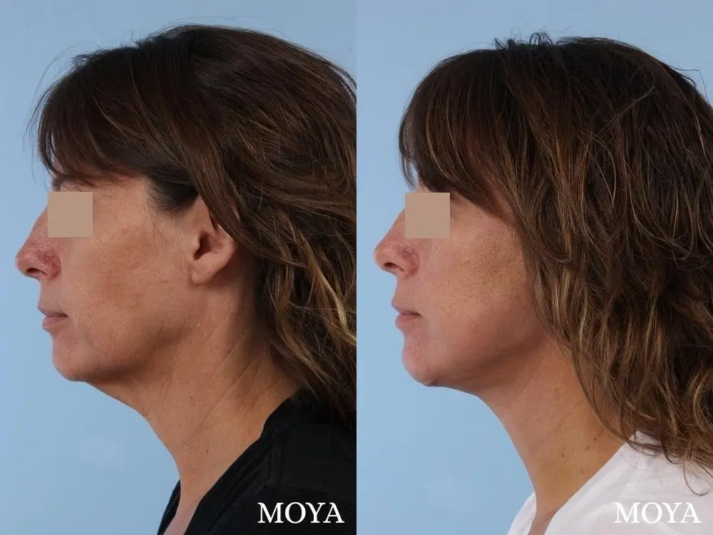 Neck Lift: Patient 1 - Before and After 2