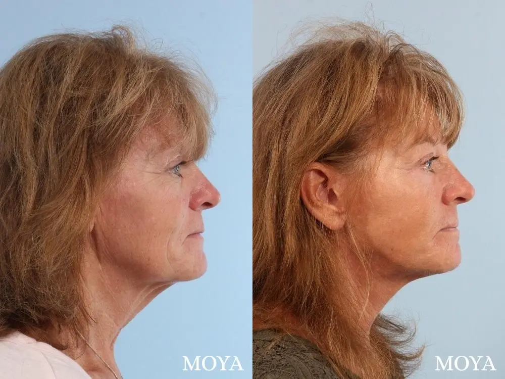 Neck Lift: Patient 3 - Before and After 2