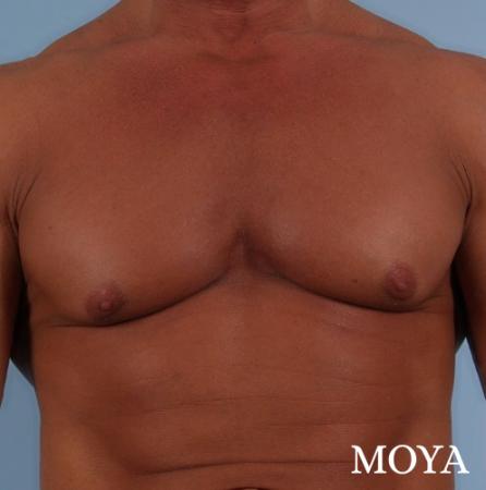 Male Breast Reduction: Patient 5 - Before and After Image 2
