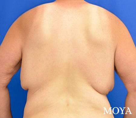 Upper Body Lift: Patient 1 - Before and After Image 3