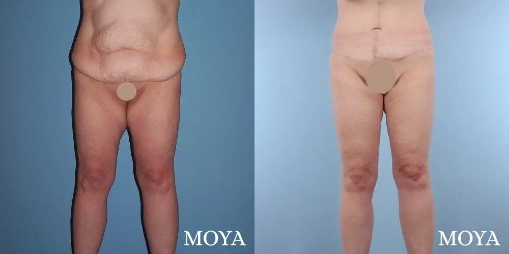 Thigh Lift: Patient 4 - Before and After 1