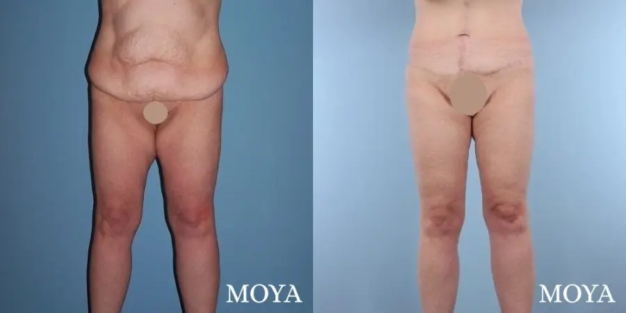 Thigh Lift: Patient 4 - Before and After  