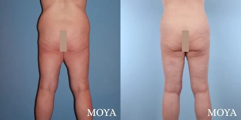 Thigh Lift: Patient 4 - Before and After 2