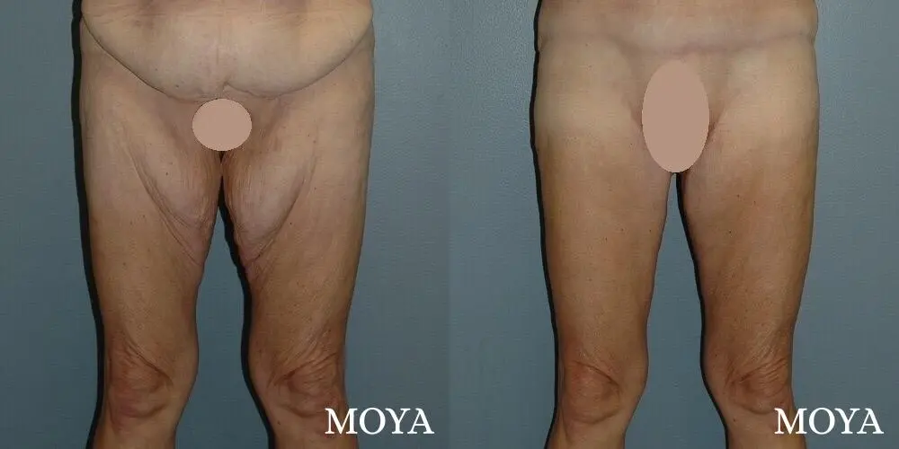 Thigh Lift: Patient 1 - Before and After 1