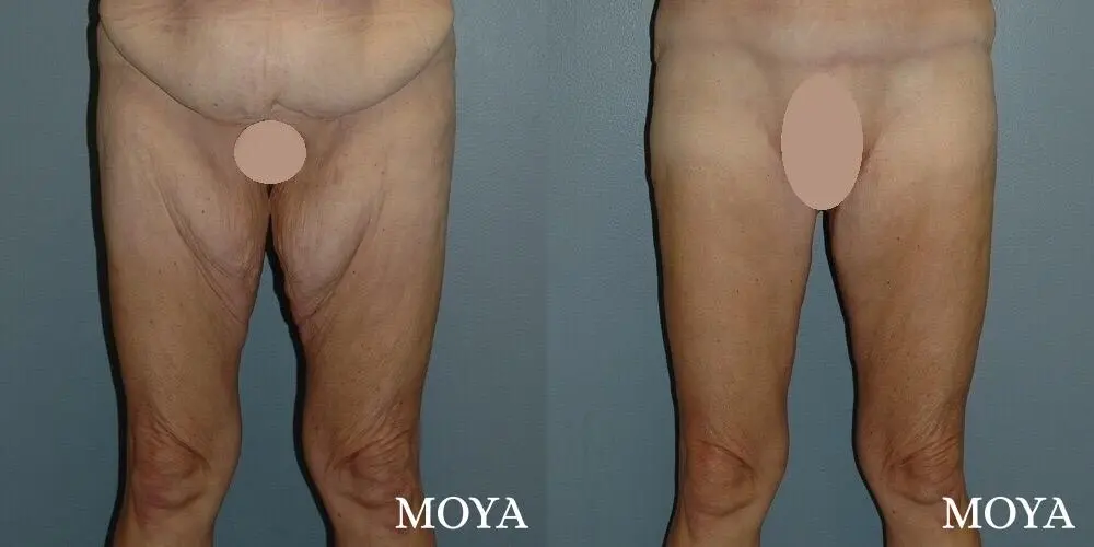 Thigh Lift: Patient 1 - Before and After  