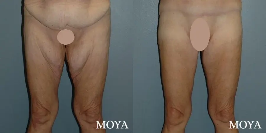 Thigh Lift: Patient 1 - Before and After  