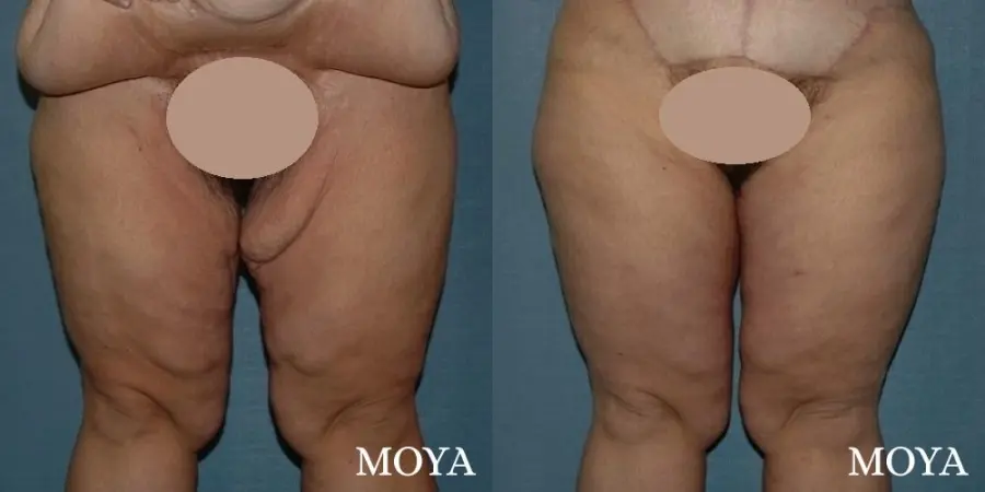 Thigh Lift: Patient 2 - Before and After  