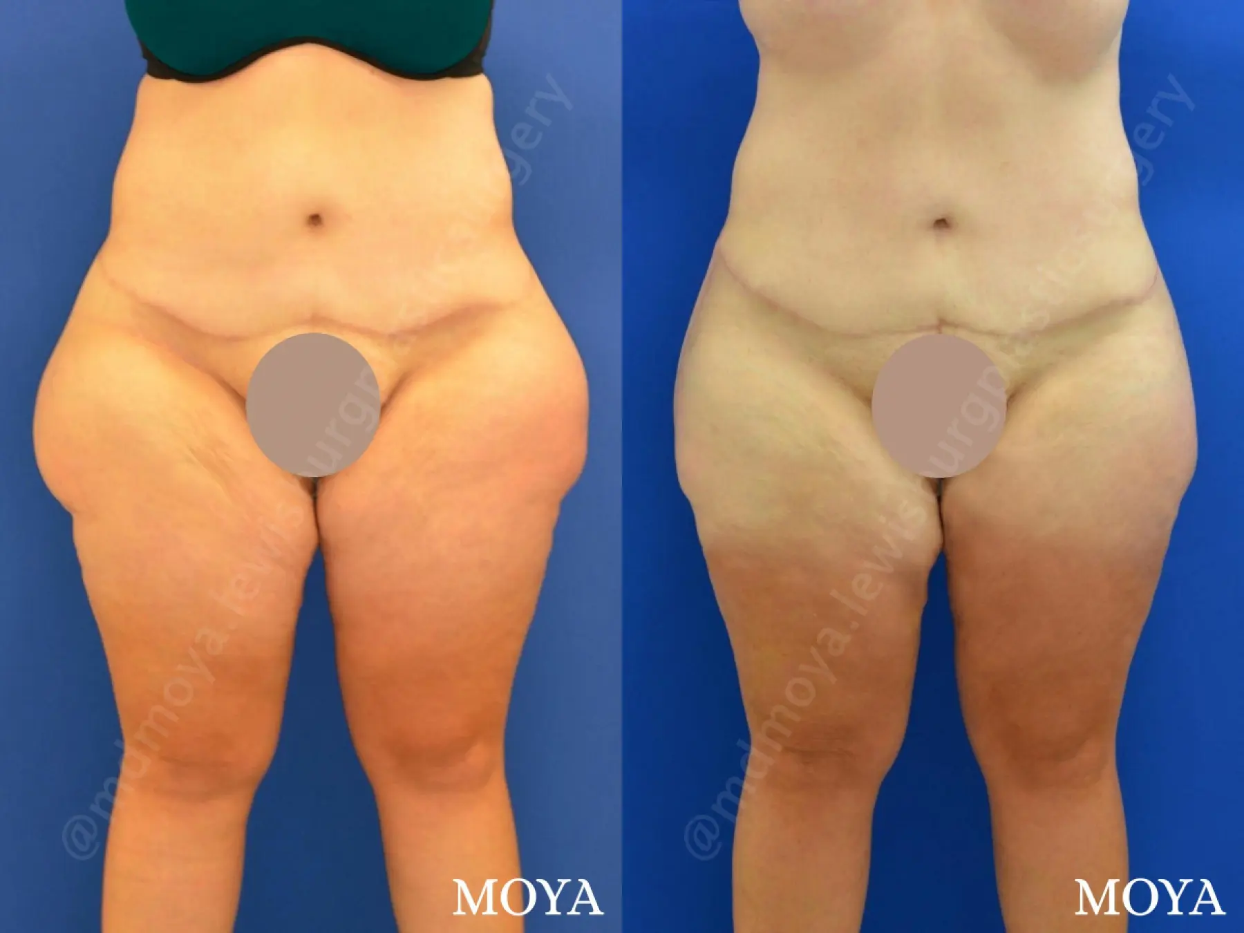 Outer Thigh Tuck - Before and After 1