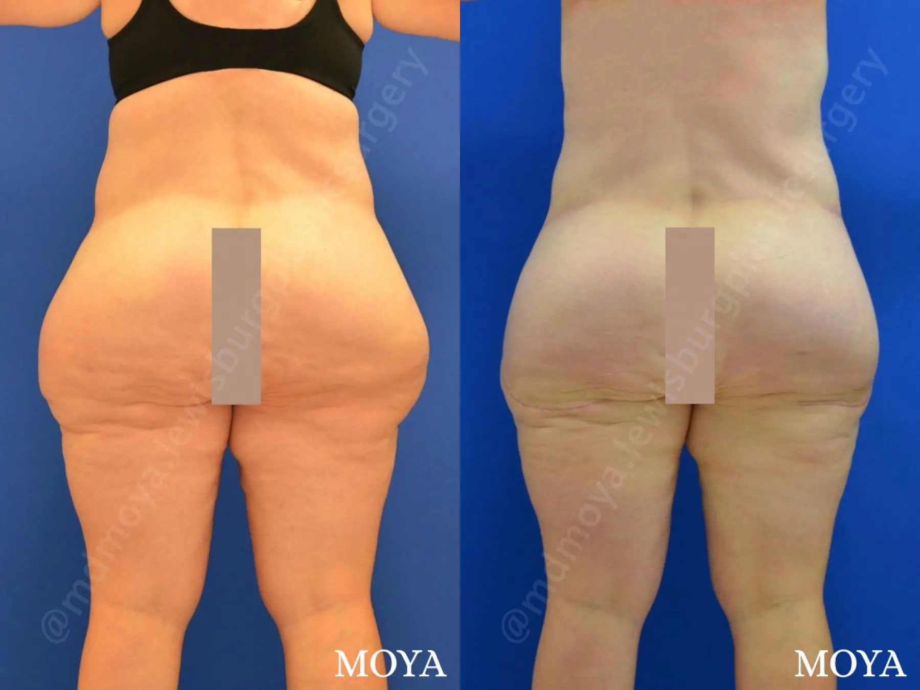 Outer Thigh Tuck - Before and After 2