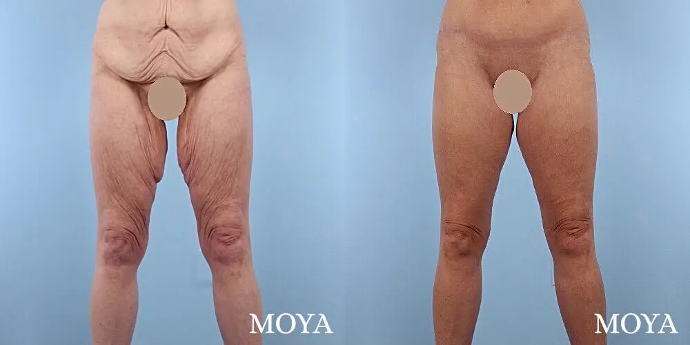 Inner Thigh Tuck - Before and After 1