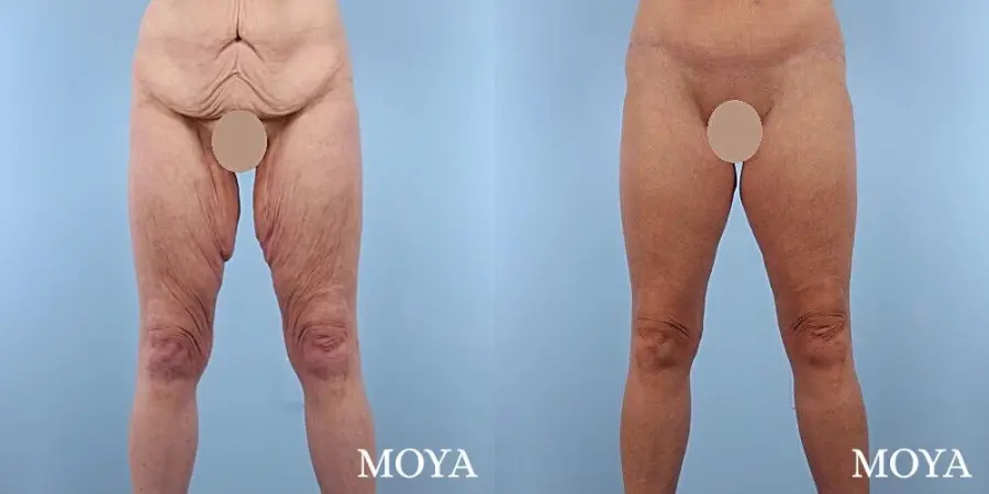Inner Thigh Tuck - Before and After  
