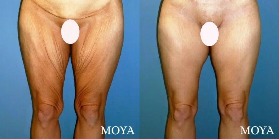 Inner Thigh Tuck - Before and After  