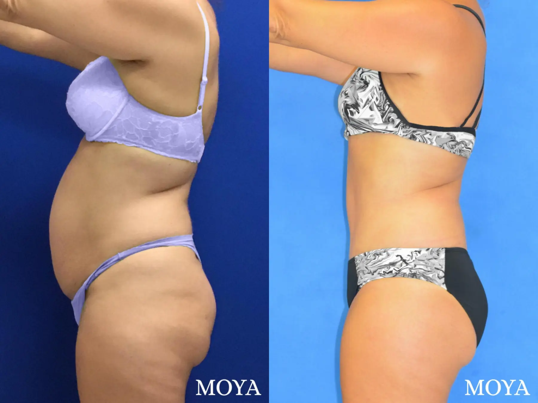 Tummy Tuck (standard) - Before and After 2