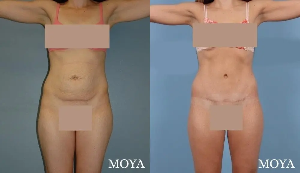 Tummy Tuck (standard) - Before and After  