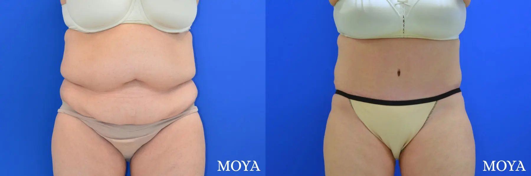 Tummy Tuck (extended) - Before and After 3