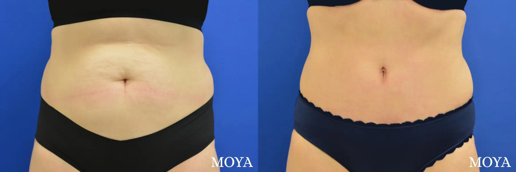 tummy tuck (standard) - Before and After 3