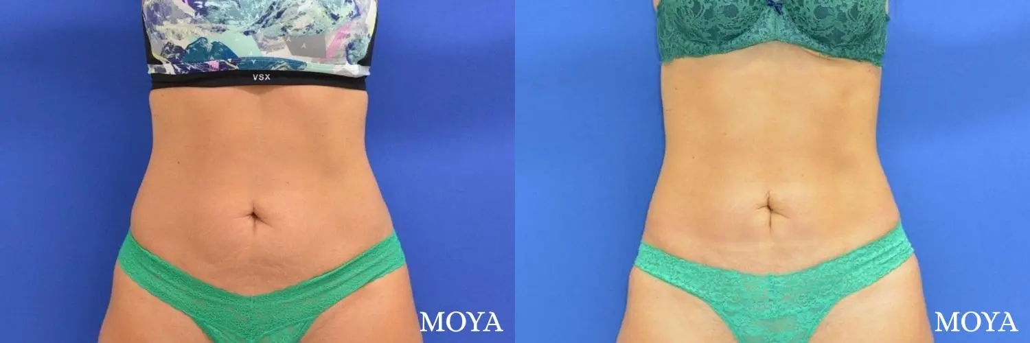 Tummy Tuck (mini):  Patient 3 - Before and After 2