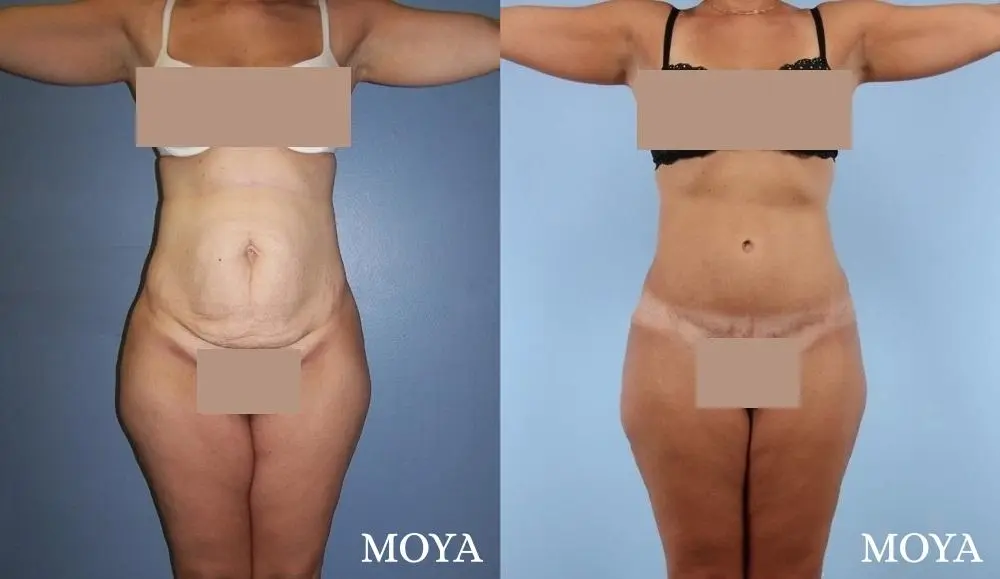 Tummy Tuck (standard) - Before and After 1