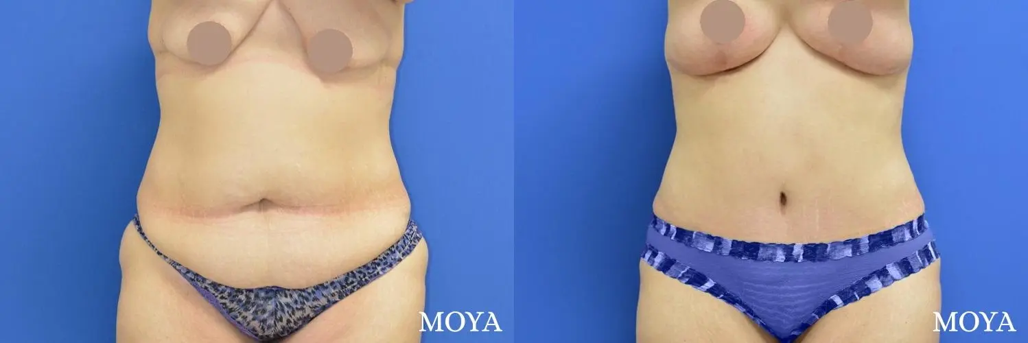 Tummy Tuck (standard) - Before and After 1