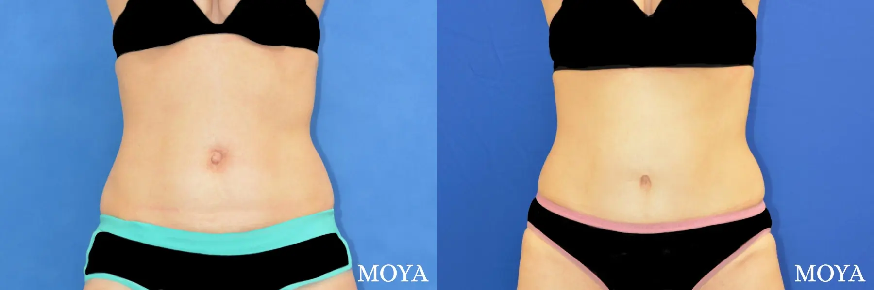 Tummy Tuck (limited) - Before and After 2