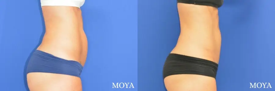 Tummy Tuck (mini):  Patient 2 - Before and After  