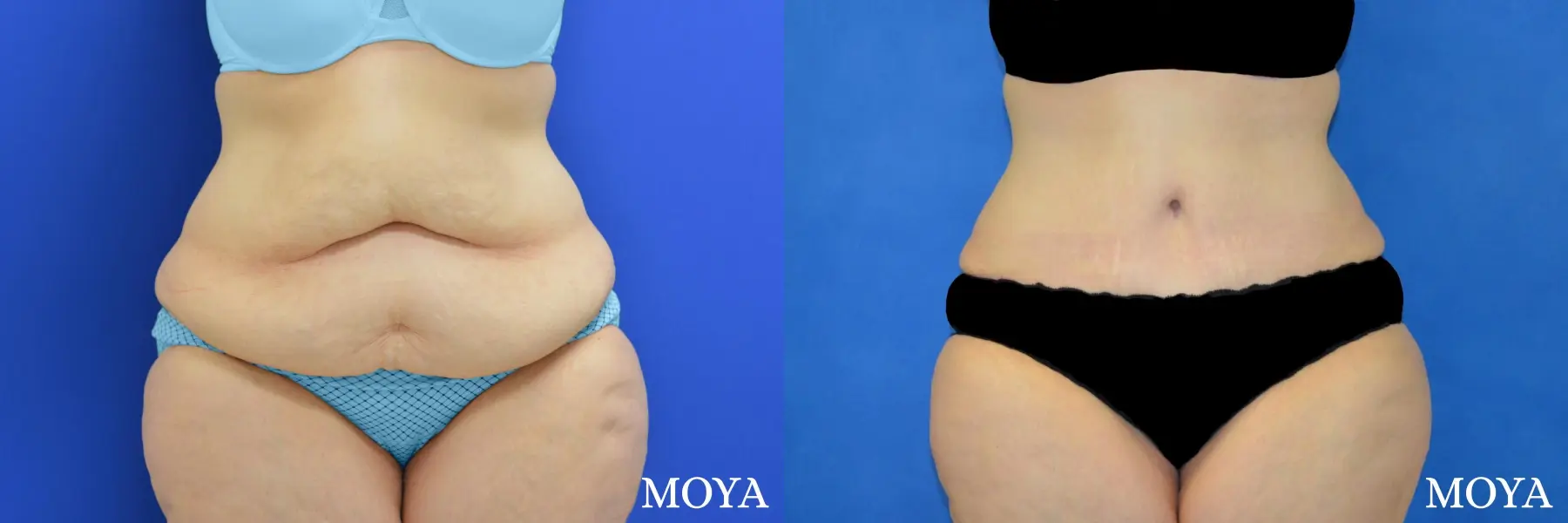 Tummy Tuck (standard) - Before and After 1