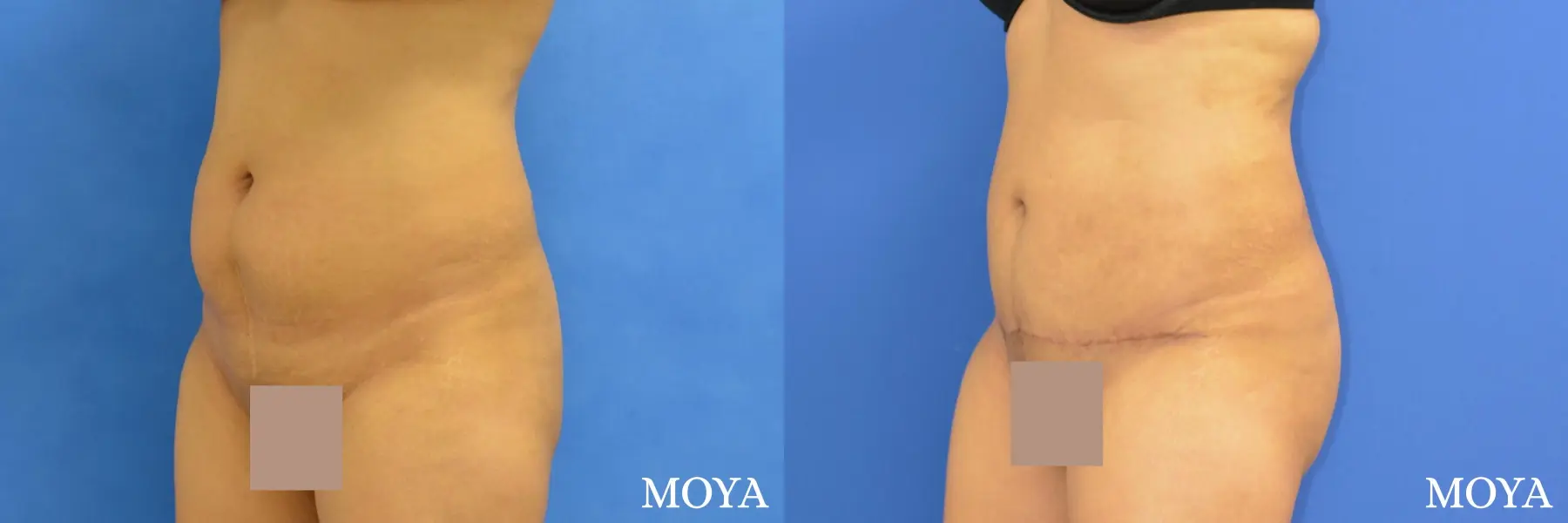Tummy Tuck (mini):  Patient 1 - Before and After  
