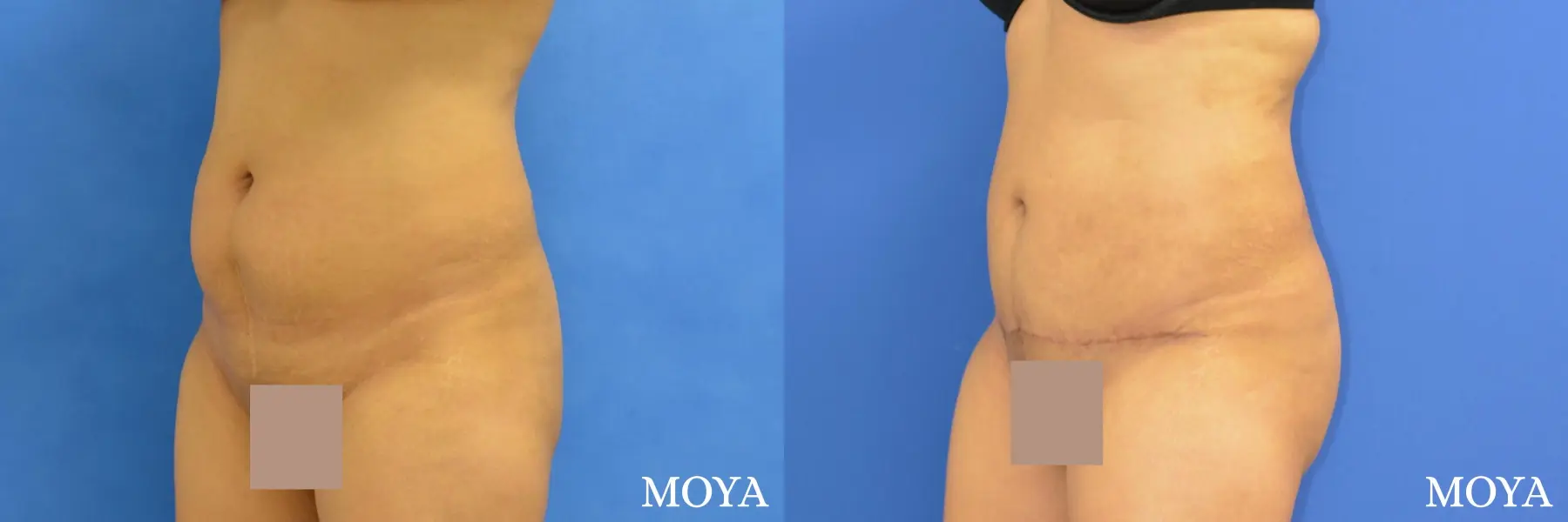 Tummy Tuck (mini):  Patient 1 - Before and After 1