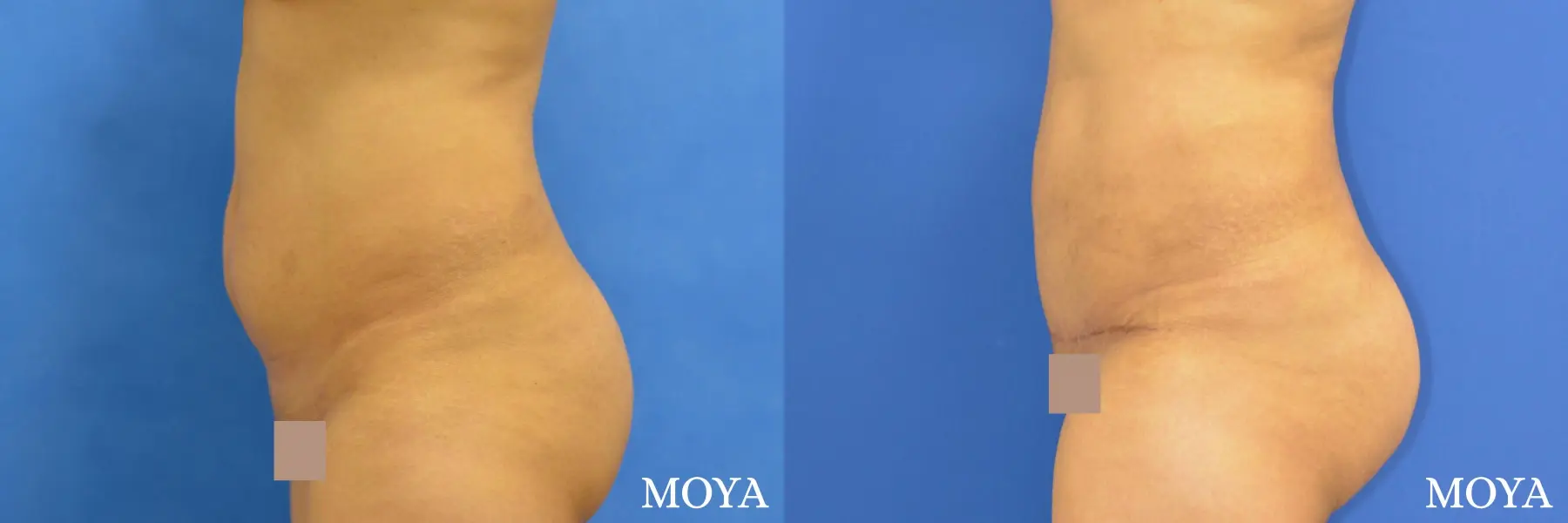 Tummy Tuck (mini):  Patient 1 - Before and After 2