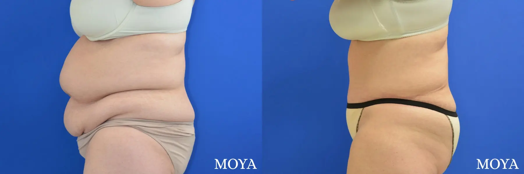 Tummy Tuck (extended) - Before and After 2
