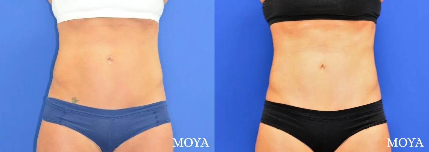 Tummy Tuck (mini):  Patient 2 - Before and After 2