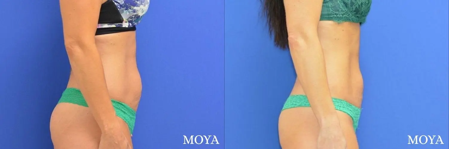 Tummy Tuck (mini):  Patient 3 - Before and After  