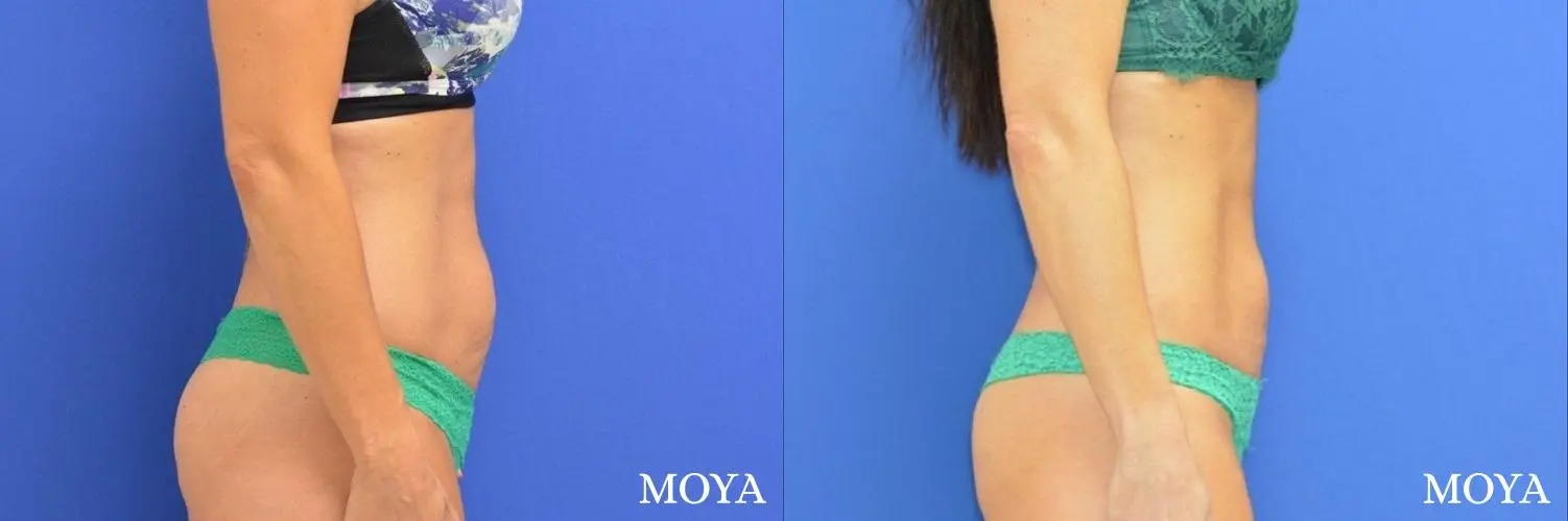 Tummy Tuck (mini):  Patient 3 - Before and After 1