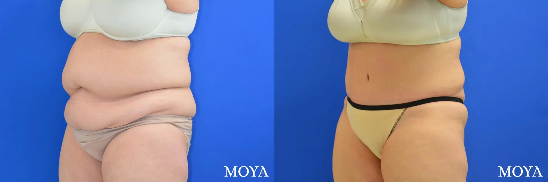 Tummy Tuck (extended) - Before and After  