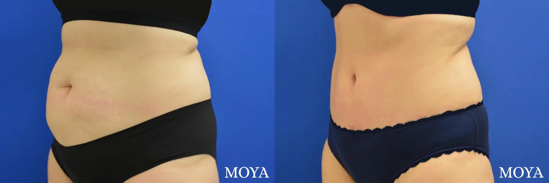 tummy tuck (standard) - Before and After 1