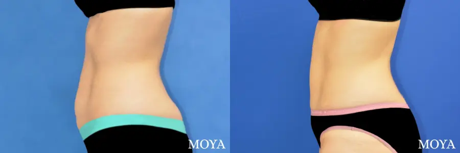 Tummy Tuck (limited) - Before and After  