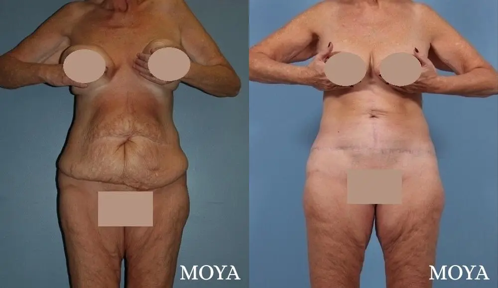 Tummy Tuck (Fleur De Lis) - Before and After  