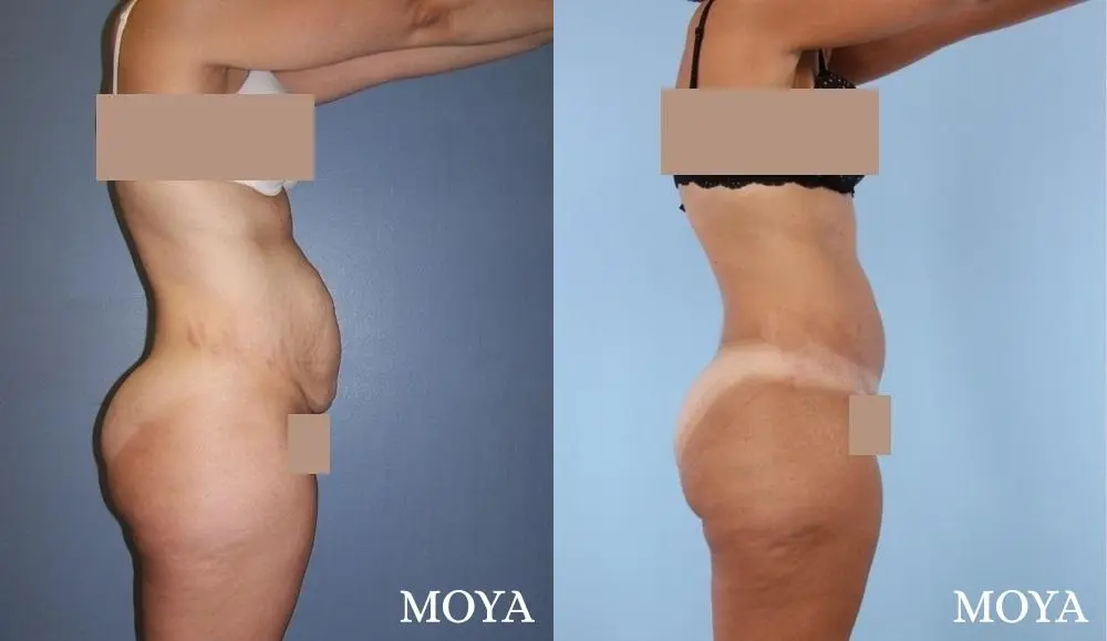 Tummy Tuck (standard) - Before and After 2