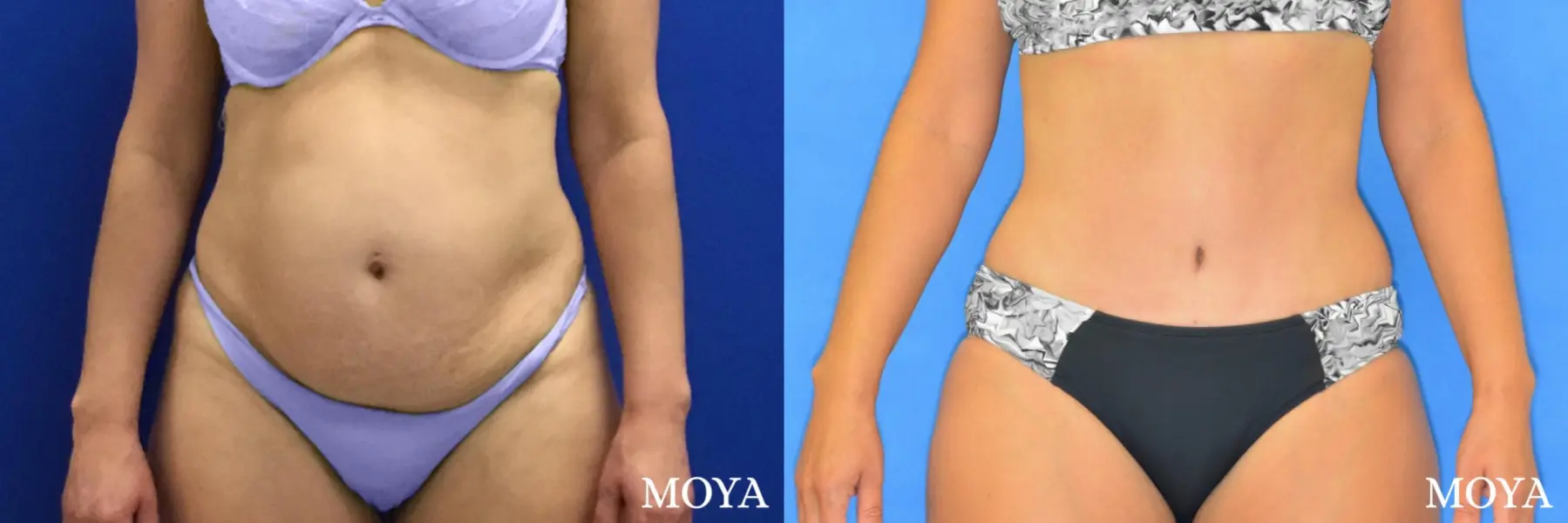 Tummy Tuck (standard) - Before and After 1