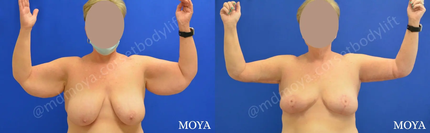 Upper Body Lift without Implants - Before and After 1