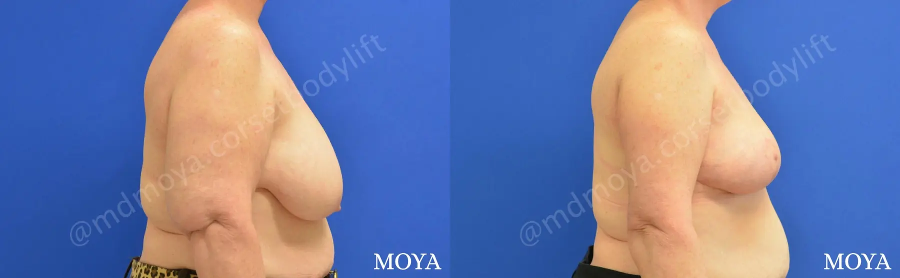 Upper Body Lift without Implants - Before and After 2