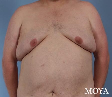 Upper Body Lift: Patient 2 - Before and After Image 2