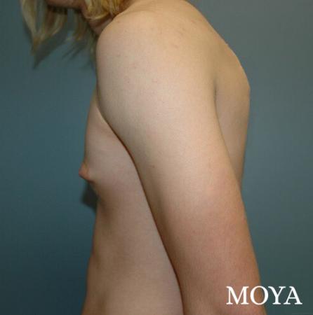 Male Breast Reduction: Patient 2 - Before Image 1
