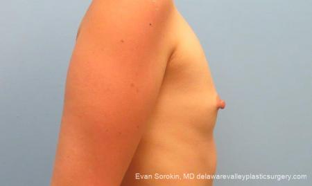 Philadelphia Breast Augmentation 10193 - Before Image 3