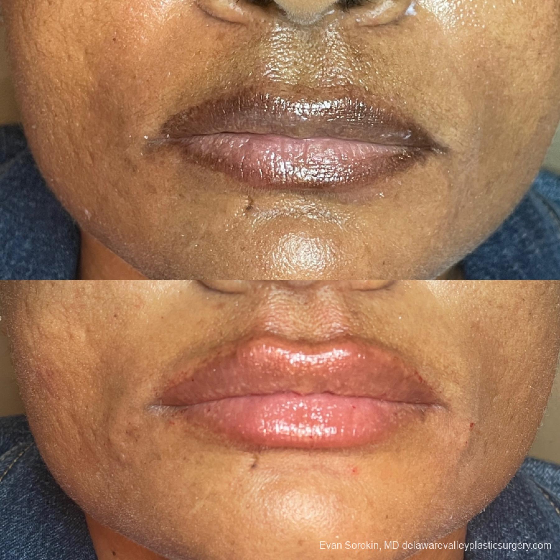 Lip Augmentation: Patient 65 - Before and After 1