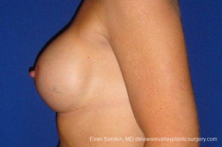 Philadelphia Breast Augmentation 9412 - After Image 5